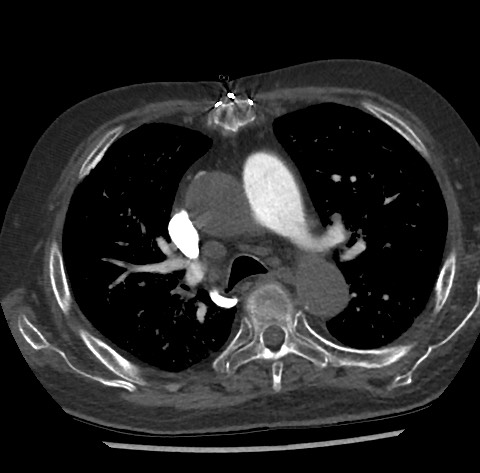 File:Chronic thromboembolic pulmonary disease (Radiopaedia 90694-108119 Axial C+ CTPA 37).jpg