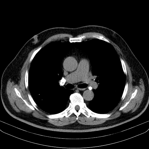 File:Classic complicated silicosis (Radiopaedia 49720-54961 Axial liver window 25).jpg