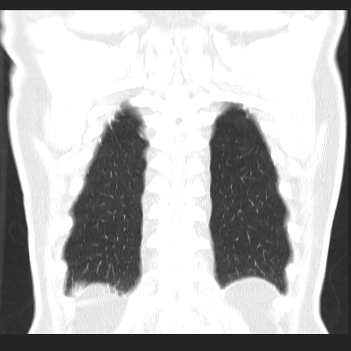 File:Classic complicated silicosis (Radiopaedia 49720-54961 Coronal lung window 55).jpg