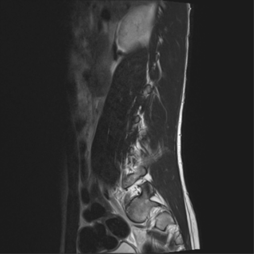 File:Clear cell meningoma - lumbar spine (Radiopaedia 60116-67690 Sagittal T2 15).png