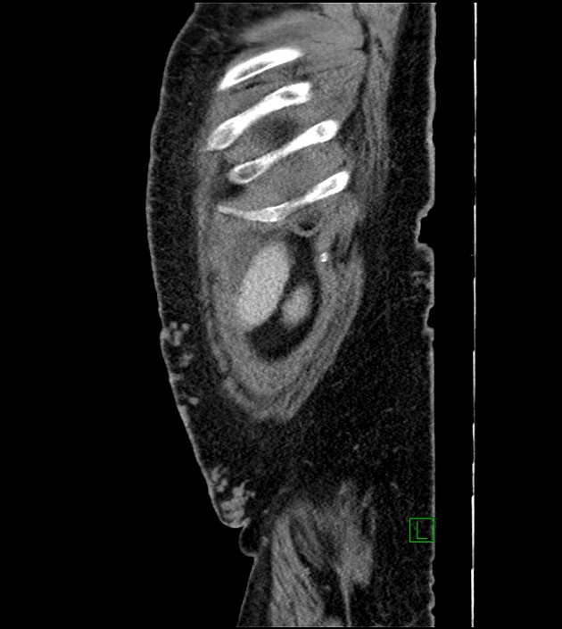 Closed-loop small bowel obstruction-internal hernia (Radiopaedia 78439-91096 C 19).jpg