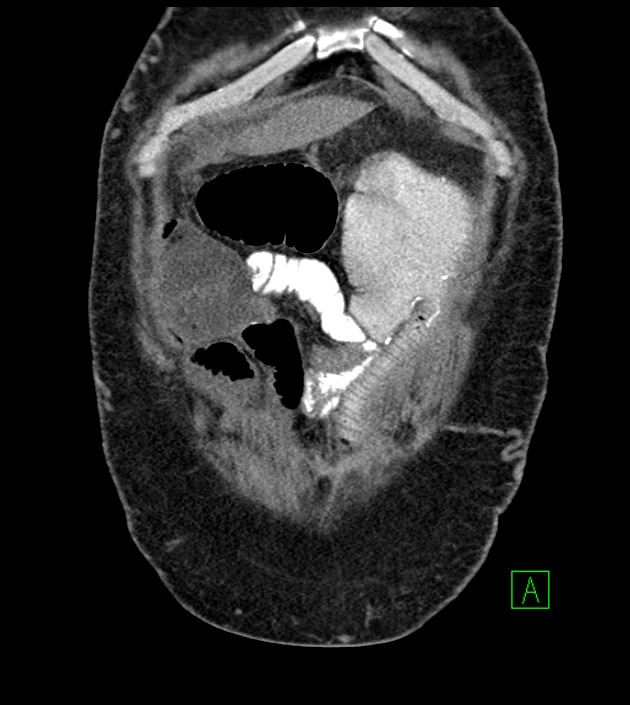 Closed-loop small bowel obstruction-internal hernia (Radiopaedia 78439-91096 Coronal non-contrast 22).jpg