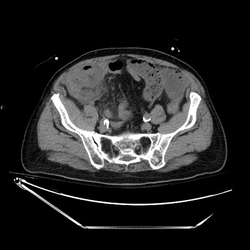 File:Closed loop obstruction due to adhesive band, resulting in small bowel ischemia and resection (Radiopaedia 83835-99023 Axial non-contrast 115).jpg