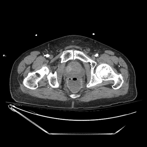 File:Closed loop obstruction due to adhesive band, resulting in small bowel ischemia and resection (Radiopaedia 83835-99023 B 152).jpg