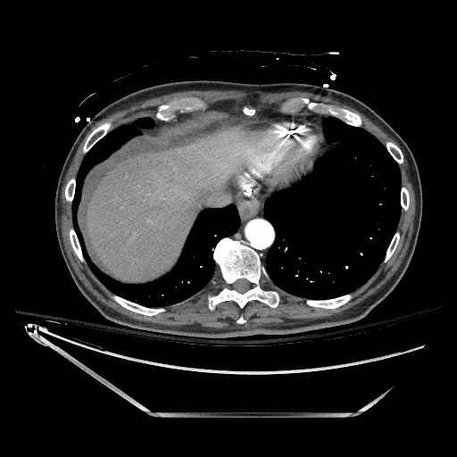 File:Closed loop obstruction due to adhesive band, resulting in small bowel ischemia and resection (Radiopaedia 83835-99023 B 21).jpg