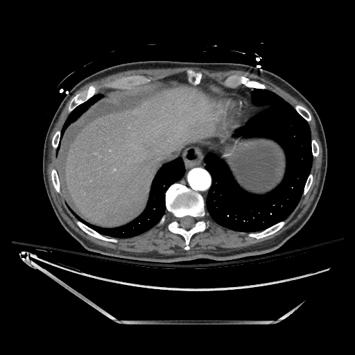 File:Closed loop obstruction due to adhesive band, resulting in small bowel ischemia and resection (Radiopaedia 83835-99023 B 24).jpg