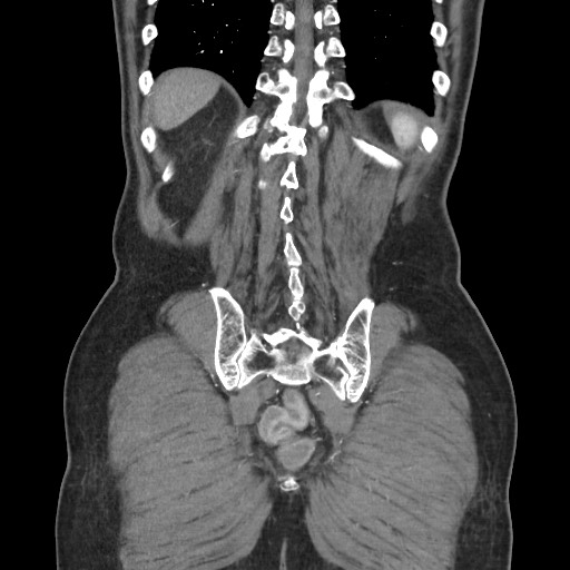 File:Closed loop obstruction due to adhesive band, resulting in small bowel ischemia and resection (Radiopaedia 83835-99023 C 104).jpg