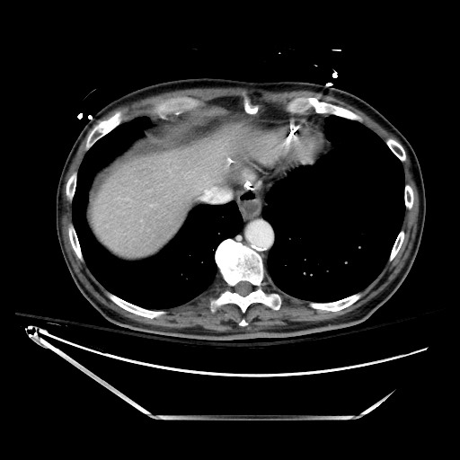 File:Closed loop obstruction due to adhesive band, resulting in small bowel ischemia and resection (Radiopaedia 83835-99023 D 22).jpg