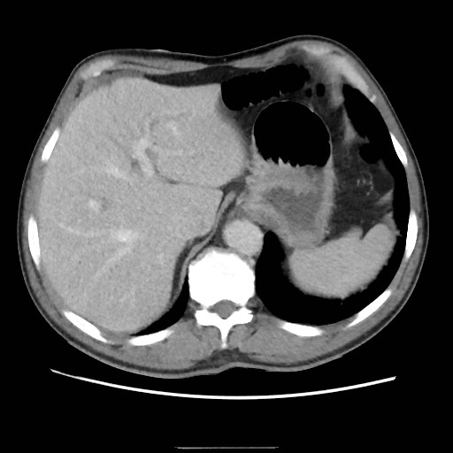 File:Closed loop small bowel obstruction (Radiopaedia 59227-66554 A 22).jpg