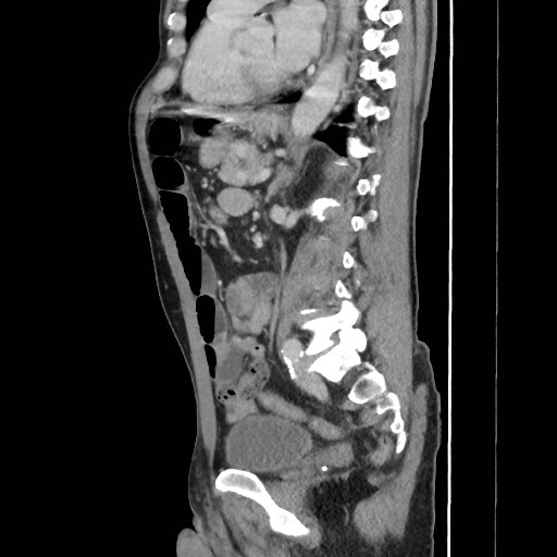 Closed loop small bowel obstruction (Radiopaedia 59227-66554 C 39).jpg