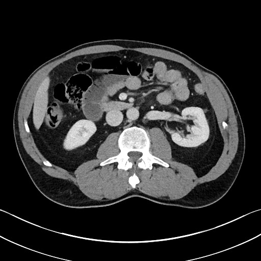File:Closed loop small bowel obstruction - internal hernia (Radiopaedia 57806-64778 B 55).jpg