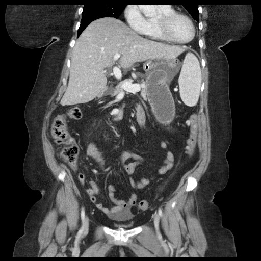 Closed loop small bowel obstruction - internal hernia (Radiopaedia 65402-74450 B 46).jpg