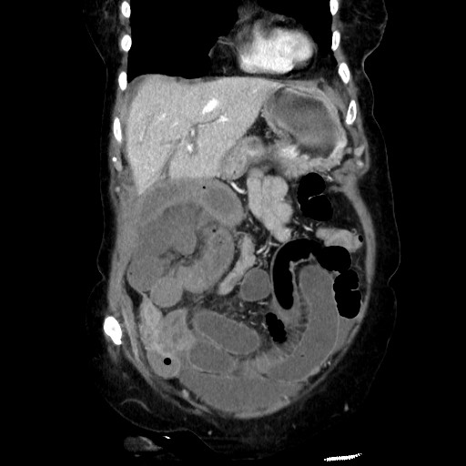 Closed loop small bowel obstruction due to adhesive band, with intramural hemorrhage and ischemia (Radiopaedia 83831-99017 C 36).jpg