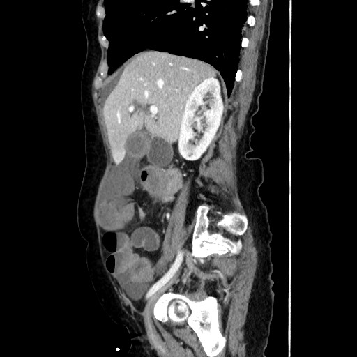 Closed loop small bowel obstruction due to adhesive band, with intramural hemorrhage and ischemia (Radiopaedia 83831-99017 D 77).jpg