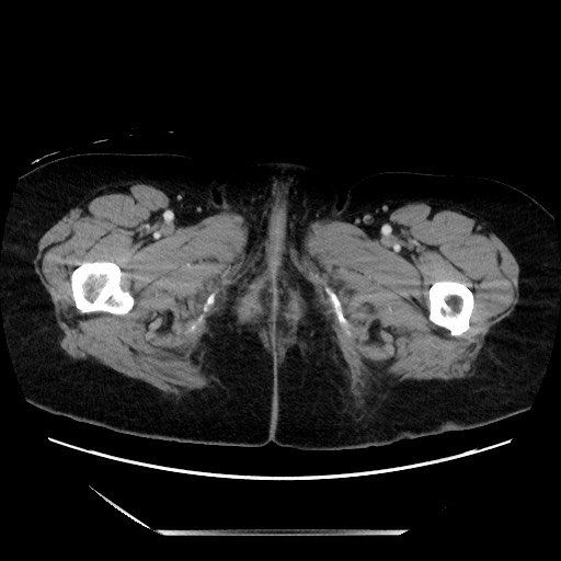 File:Closed loop small bowel obstruction due to adhesive bands - early and late images (Radiopaedia 83830-99014 A 176).jpg