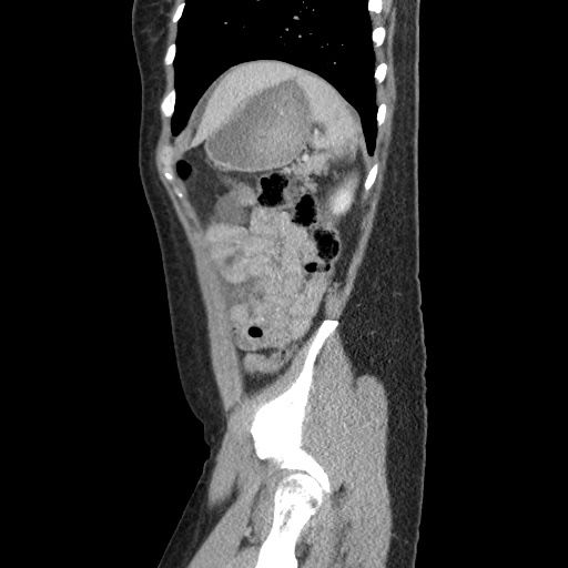 Closed loop small bowel obstruction due to trans-omental herniation (Radiopaedia 35593-37109 C 53).jpg