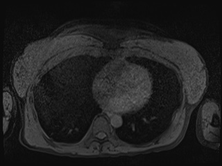 Closed loop small bowel obstruction in pregnancy (MRI) (Radiopaedia 87637-104031 Axial T1 fat sat 2).jpg