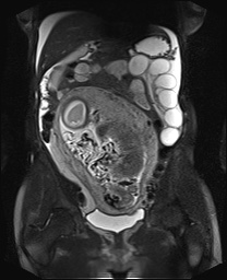 File:Closed loop small bowel obstruction in pregnancy (MRI) (Radiopaedia 87637-104031 Coronal T2 fat sat 28).jpg