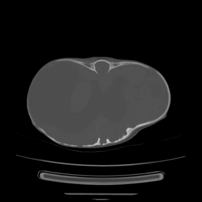 Cloverleaf skull (Radiopaedia 91901-109710 Axial bone window 101).jpg