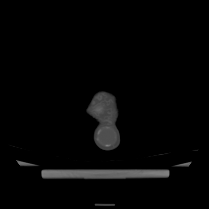 Cloverleaf skull (Radiopaedia 91901-109710 Axial bone window 145).jpg