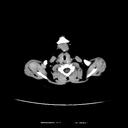Cloverleaf skull (Radiopaedia 91901-109710 Axial non-contrast 13).jpg