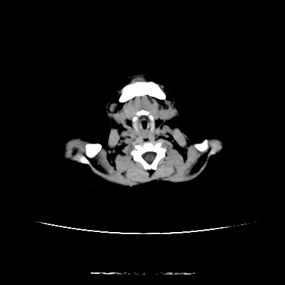 File:Cloverleaf skull (Radiopaedia 91901-109710 Axial non-contrast 19).jpg