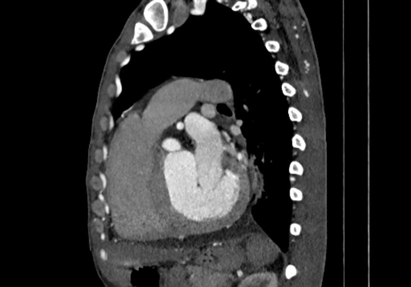 Coarctation of aorta with aortic valve stenosis (Radiopaedia 70463-80574 B 103).jpg