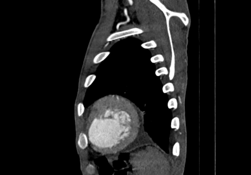 Coarctation of aorta with aortic valve stenosis (Radiopaedia 70463-80574 B 212).jpg