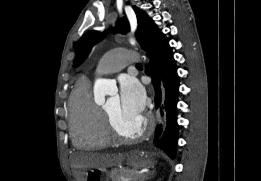 Coarctation of aorta with aortic valve stenosis (Radiopaedia 70463-80574 B 90).jpg