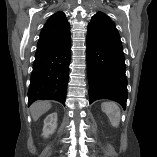 File:Coarctation of the aorta (Radiopaedia 17427-17116 A 25).jpg
