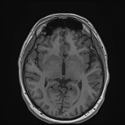Cochlear incomplete partition type III associated with hypothalamic hamartoma (Radiopaedia 88756-105498 Axial T1 99).jpg