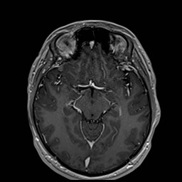 Cochlear incomplete partition type III associated with hypothalamic hamartoma (Radiopaedia 88756-105498 Axial T1 C+ 91).jpg