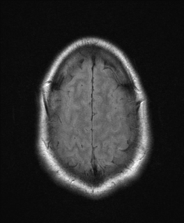 File:Colloid cyst (Radiopaedia 44510-48181 Axial FLAIR 25).png