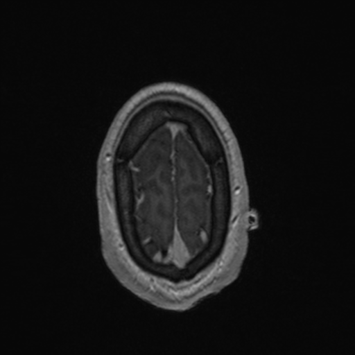 File:Colloid cyst (Radiopaedia 44510-48181 Axial T1 C+ 163).png