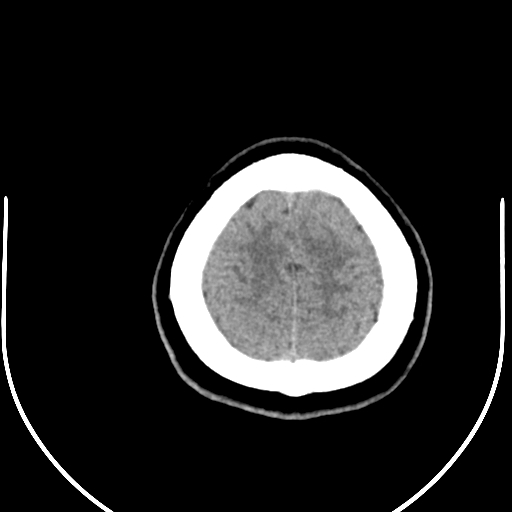 Colloid cyst (Radiopaedia 52865-58792 Axial non-contrast 13).jpg