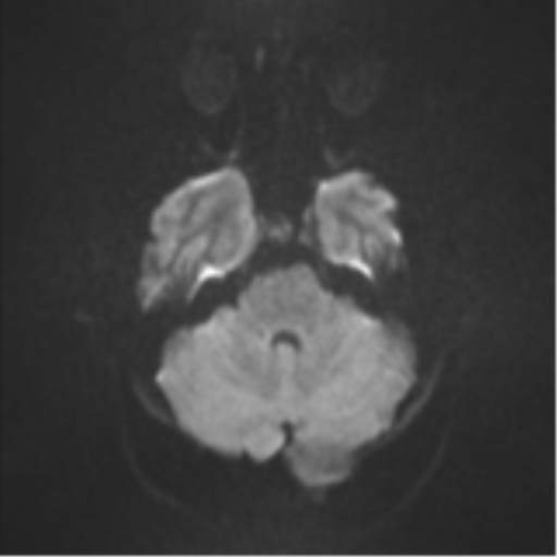 Colloid cyst (Radiopaedia 53164-59125 Axial DWI 35).png