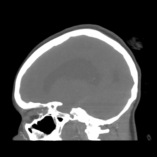 File:Colloid cyst (resulting in death) (Radiopaedia 33423-34499 B 35).png