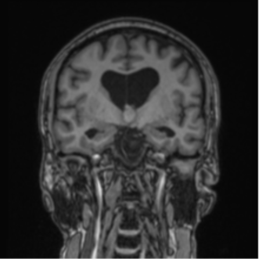 Colloid cyst of the third ventricle (Radiopaedia 86571-102662 Coronal T1 52).png