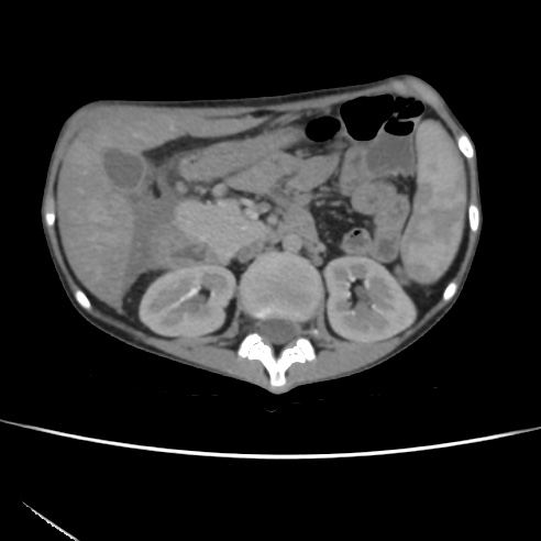 File:Colocolic fistula - Crohn disease (Radiopaedia 57063-63955 A 28).jpg