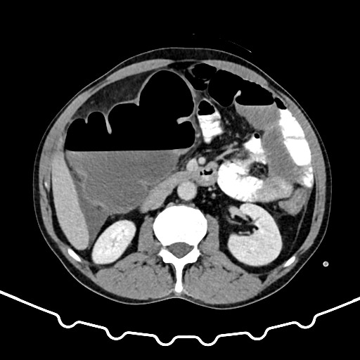 File:Colocolic intussusception due to large lipoma (Radiopaedia 68773-78482 A 77).jpg