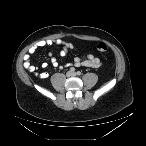 File:Colocolic intussusception due to lipoma (Radiopaedia 73712-84508 Axial 76).jpg