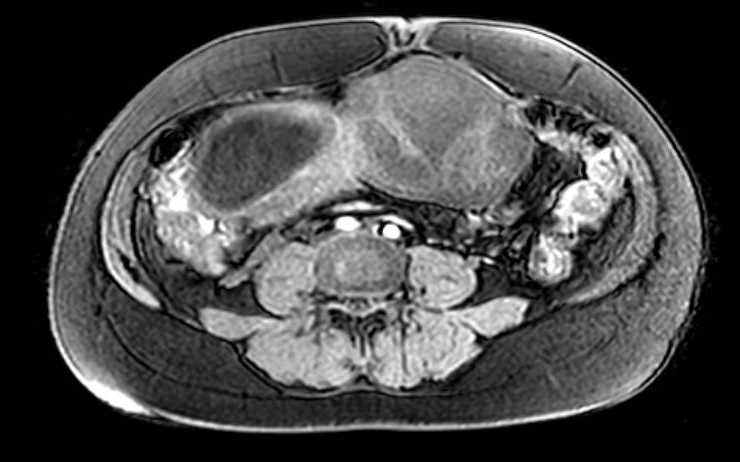 File:Colon adenocarcinoma with Krukenberg tumors, advanced pregnancy (Radiopaedia 67279-76645 A 37).jpg