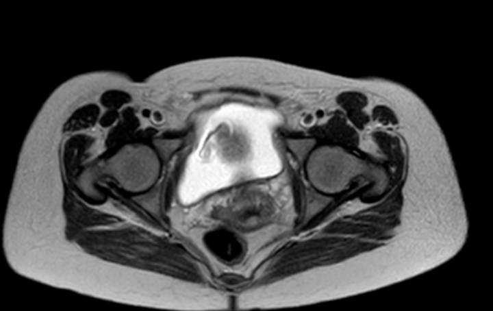 Colon adenocarcinoma with Krukenberg tumors, advanced pregnancy (Radiopaedia 67279-76645 Axial T2 7).jpg
