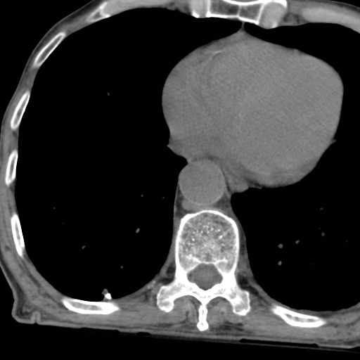 File:Colon cancer with calcified liver metastasis (Radiopaedia 74423-85309 Axial non-contrast 4).jpg