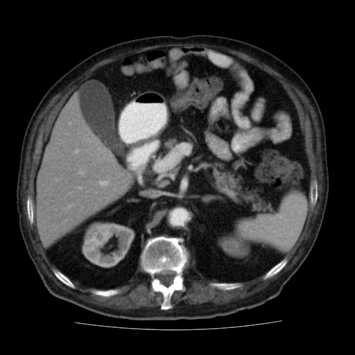 File:Colon cancer with duodenal invasion (Radiopaedia 16278-15958 A 19).jpg