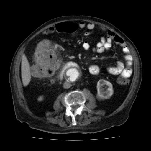 File:Colon cancer with duodenal invasion (Radiopaedia 16278-15958 A 31).jpg