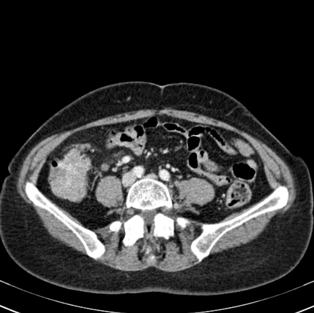 Colon carcinoma with hepatic metastases (Radiopaedia 29477-29961 A 74).jpg