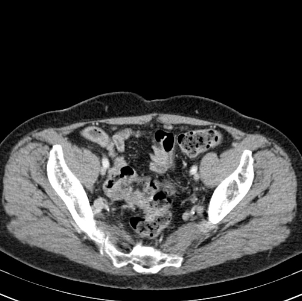 Colon carcinoma with hepatic metastases (Radiopaedia 29477-29961 A 96).jpg