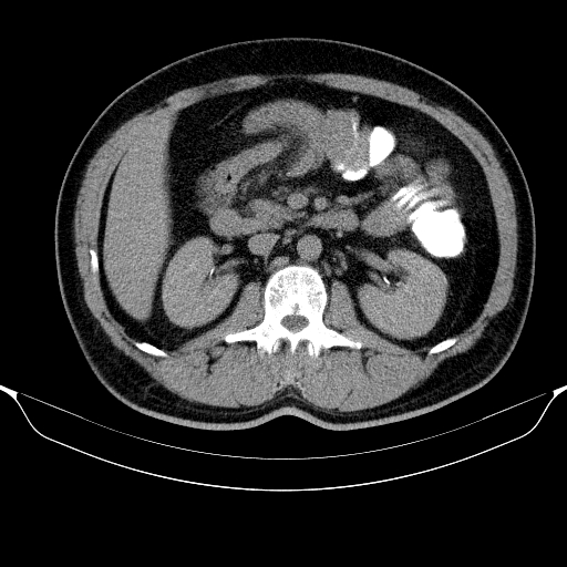 Colonic lipoma with colo-colic intussusception (Radiopaedia 58944-66200 Axial C+ rectal 23).jpg