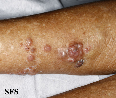 File:Melanoma (Dermatology Atlas 64).jpg